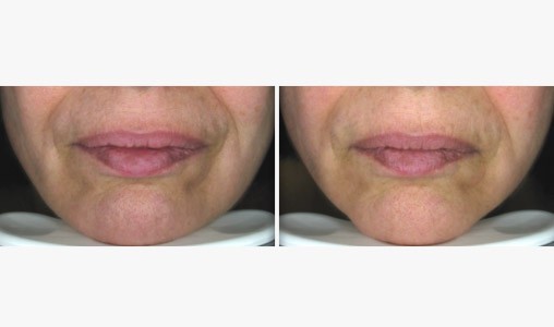 resultat lift essentiel spa